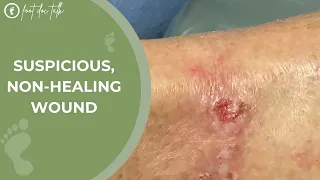 Suspicious Non-Healing Wound