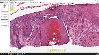 Squamous cell carcinoma versus basal cell carcinoma.