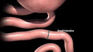 Rex Bariatrics: Gastric Bypass Surgery Explained