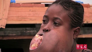 Girl Has Football-Sized Tumour On Her Face: Body Bizarre Episode 6