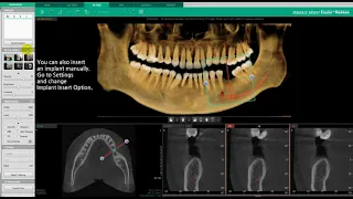 Ez3D-i | 3D PAN Tab | Inserting an Implant & Virtual Crown Simulation