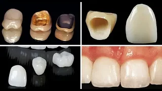 أسباب أختلاف أسعار وكلفة تركيب الأسنان و إبتسامة هوليود بين طبيب أسنان وأخر