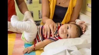 Treating Every Child with Clubfoot