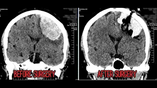 1 year after Hemorrhagic Stroke