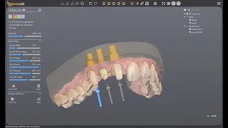 Webinar integrazione Implant 3D&HypsoCad