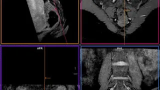 MR Lumbar Plexus - 3D DESS @ 1.5T