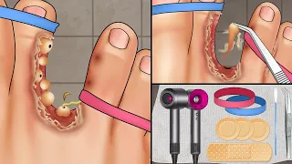 ASMR Treatment athlete's foot and warts between toes at home   Foot care animation