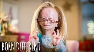 Meet Adalia Rose, the 11 year old girl who ages too fast