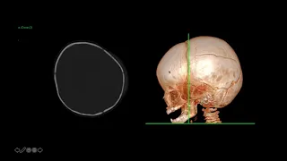 Trauma - Imaging Paediatric Trauma and Inflicted Injury - Dr J Danin - 1Dec2020