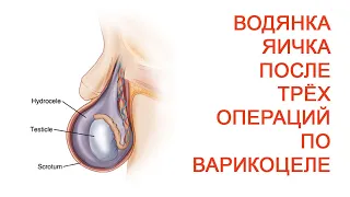 Водянка яичка после трех операций по варикоцеле / Доктор Черепанов