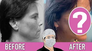 Before & After Results Are In! (Dr. Santos)