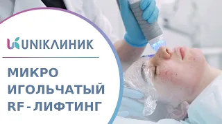 📍 Преимущества микроигольчатого RF-лифтинга на аппарате VIVACE. Микроигольчатый RF-лифтинг Vivace.