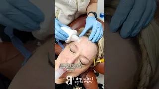 Medium Depth Chemical Peel Using Solid CO2 (Dry Ice) & TCA | Integrated Aesthetics | Dr. Chiang