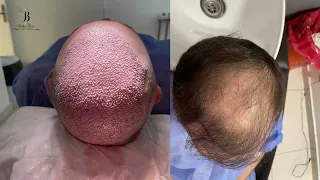hair transplant 5000 grafts in Bellus clinic, Istanbul / Turkey