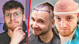 Haartransplantation: Gefährlicher Hype bei YouTubern?