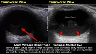 Eye Ultrasound Reporting | Cataract, Retinal Detachments, Vitreous Hemorrhage, USG Case Reports