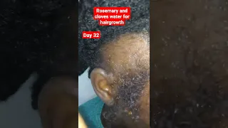 Trying Rosemary and cloves water for hair growth(day 32).