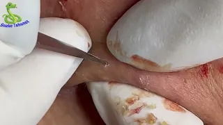 Make Your Day Relaxing with Loan Nguyen Official, Snake Tahunet Remove Blackhead