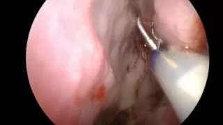 Endoscopic Sphenoid Balloon Sinuplasty with Trans illumination