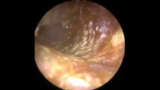 Ear Wax Removal in Twisty  Narrow and Hairy Ear Canal  By Doctor Rada