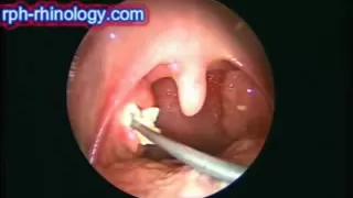 Tonsil Follicle