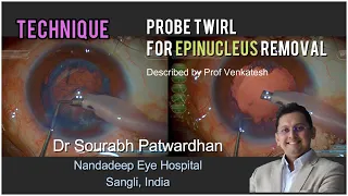 247 epinucleus removal by Probe twirl described by Prof Venkatesh: Dr Souarbh Patwardhan