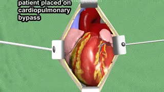 LVAD Mag/Lev Left Ventricular Assist Device - Animation by Cal Shipley, M.D.