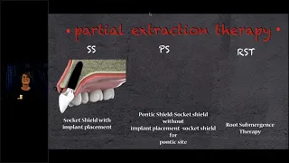 BEGO Implant Systems – Webinar – Partial Extraction Therapy Socket Shield (język angielski)