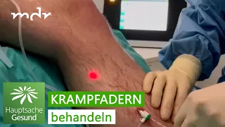 Neue Behandlungsmethoden bei Krampfadern – das ist state of the art | MDR