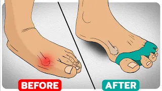 How to Get Perfect Toe Alignment