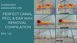 PERFECT EAR CANAL PEEL AND EAR WAX REMOVAL COMPILATION   EP 149