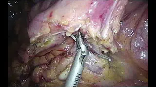 Laparoscopic extended mesenterectomy in ileocolic resection in Crohn’s disease