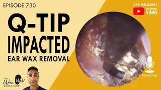 730 - Q-tip Impacted Ear Wax Removal