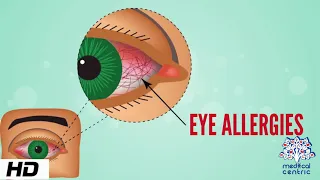 Eye Allergy, Causes, Signs and Symptoms, Diagnosis and Treatment.