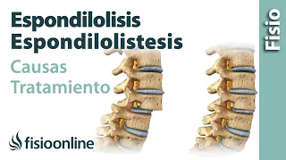 Espondilolisis y espondilolistesis - Qué es, causas, síntomas y tratamiento