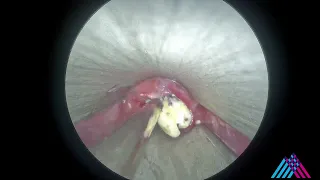 Zenker’s diverticulum minimally invasive repair