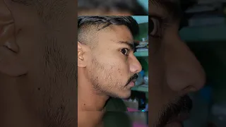 my 3 months result of Minoxidil 5% for beards 🧔 ||beard journey||minoxidil video||satisfaction 😁||