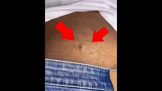 Pimple and blackhead popping Satisfying popping compilation 1 hour Edition #acne #newvideo #viral