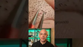 Derm reacts to stubborn ingrown hair removal! #dermreacts #doctorreacts #ingrownhair