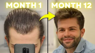How I Regrew My Hair With 3 Proven Treatments (Month-By-Month)