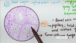Histopathology of Renal Cell Carcinoma