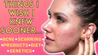 5 Things About Acne Nobody Will Tell You