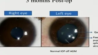 AIOC2018 - FP728 - Glaucoma II - Topic - "To Compare Outcomes of An- terior  .."