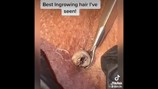 Best Ingrown Hair Removal! #facebook #4u #youtube #tiktok #fyp #foryou #fypシ #4up #viral #cyst