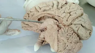 Lateral ventricle of Brain/Neuroanatomy