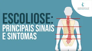 Escoliose: Principais sinais e sintomas