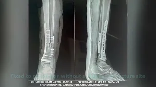 A bad comminuted fracture of distal tibia and fibula fixed perfectly