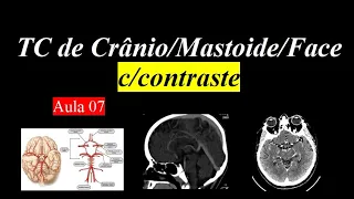 Curso de Tomografia c/contraste - Aula 7 (Crânio/Mastoide/Face)