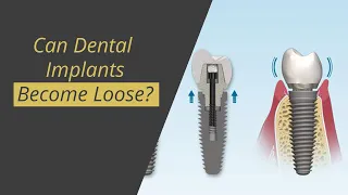 Can Dental Implants Become Loose?