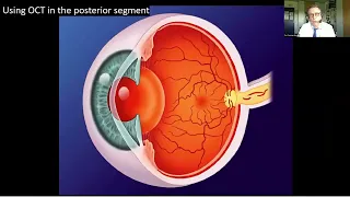 Lecture: Improved Perioperative Management of Cataract Surgery Using OCT Technology